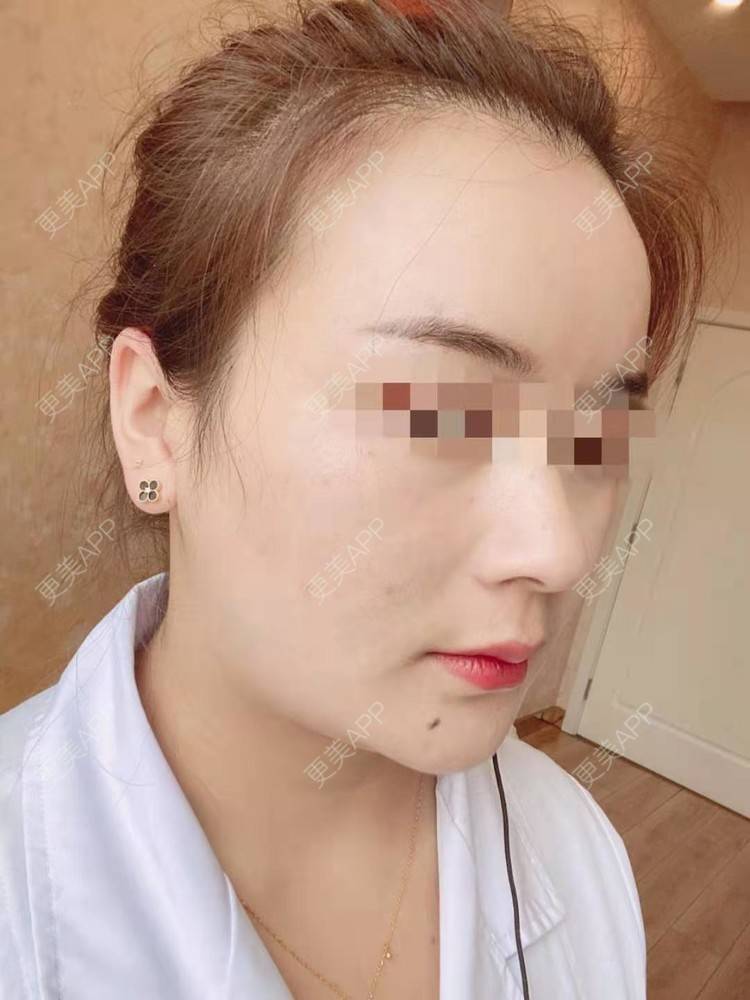 更美 - 笑忘罢衣的PRP自体血清美肤经验 | PRP自体血清美肤