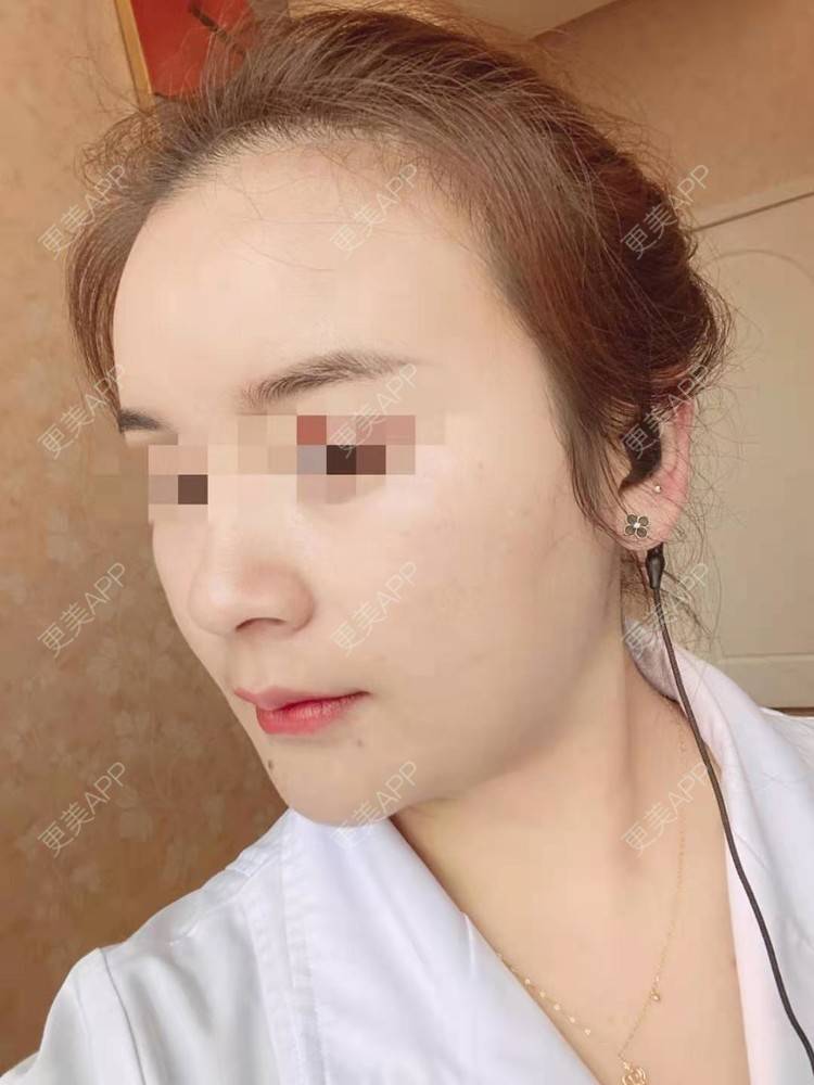 更美 - 笑忘罢衣的PRP自体血清美肤经验 | PRP自体血清美肤