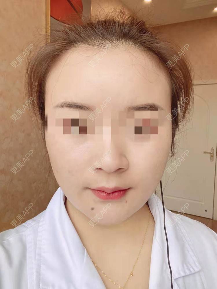 更美 - 笑忘罢衣的PRP自体血清美肤经验 | PRP自体血清美肤