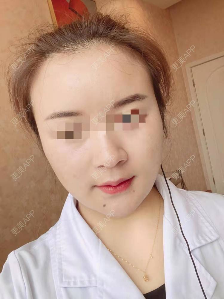 更美 - 笑忘罢衣的PRP自体血清美肤经验 | PRP自体血清美肤