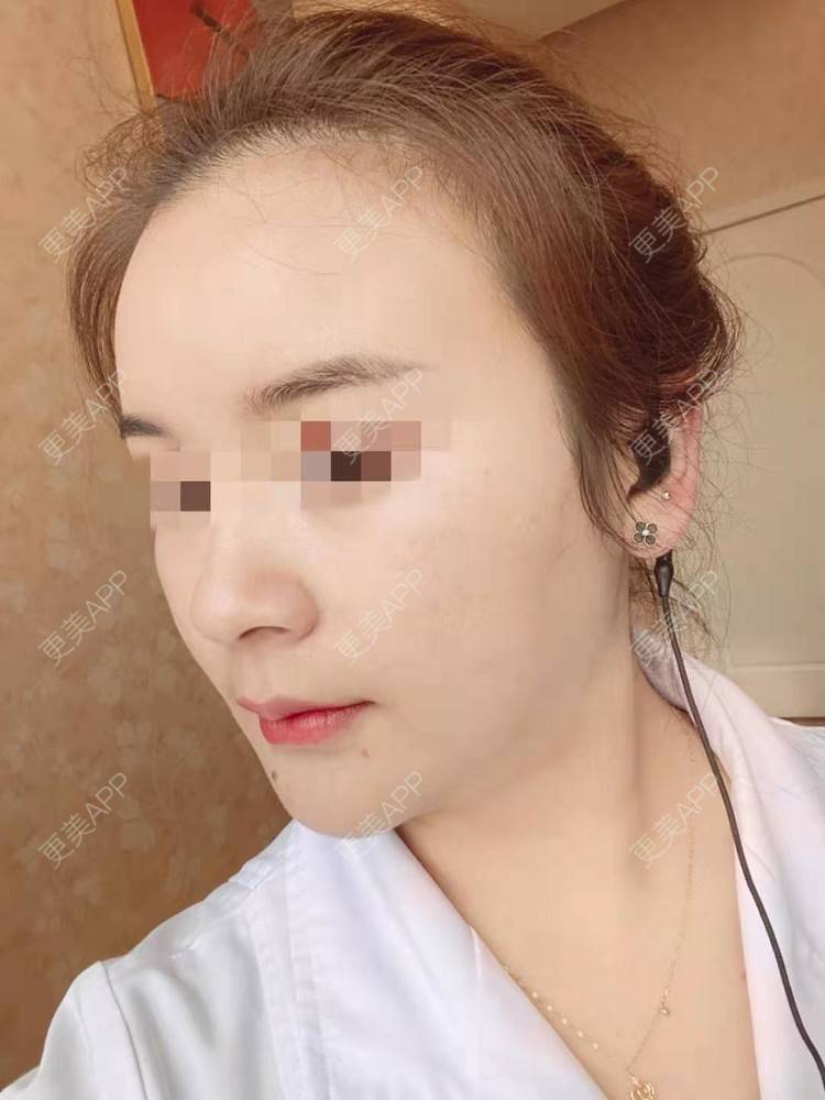 更美 - 笑忘罢衣的PRP自体血清美肤经验 | PRP自体血清美肤