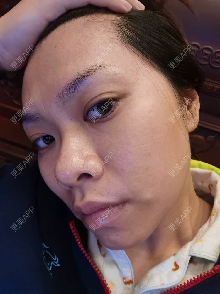更美 - 油腻叉烧包的皮秒激光经验 | 广州 | 皮秒激光