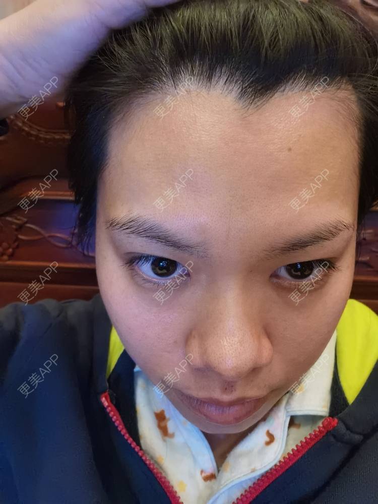 更美 - 油腻叉烧包的皮秒激光经验 | 广州 | 皮秒激光