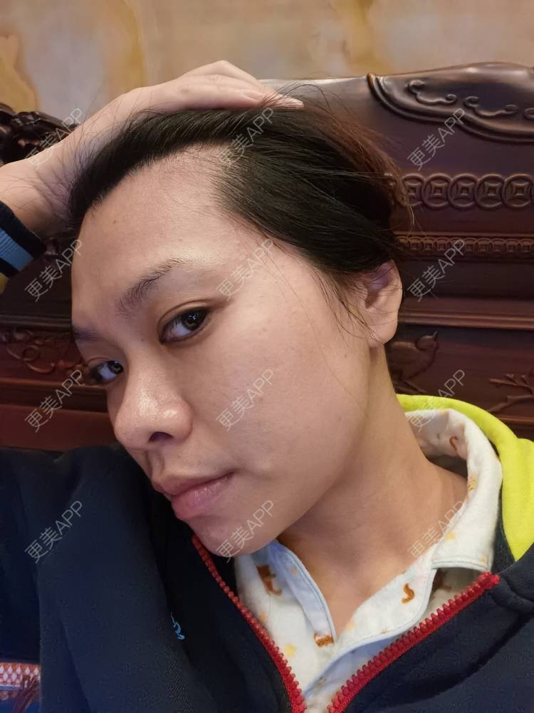 更美 - 油腻叉烧包的皮秒激光经验 | 广州 | 皮秒激光