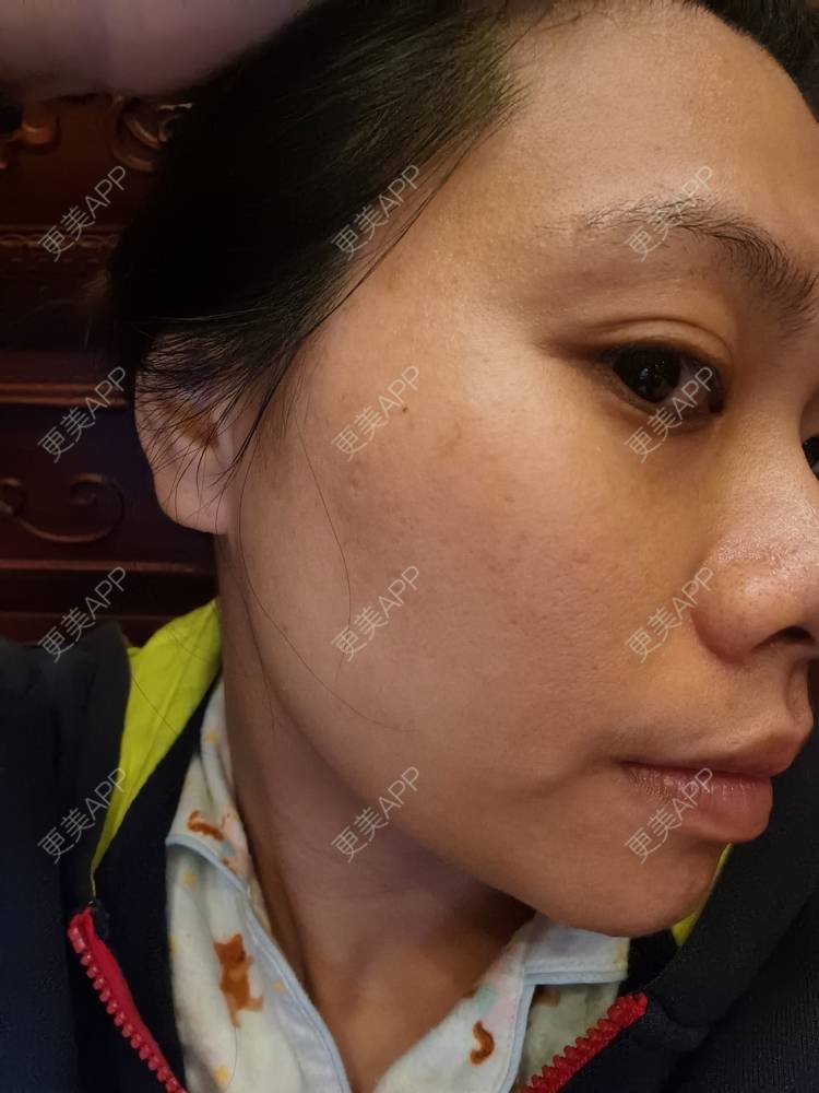 更美 - 油腻叉烧包的皮秒激光经验 | 广州 | 皮秒激光