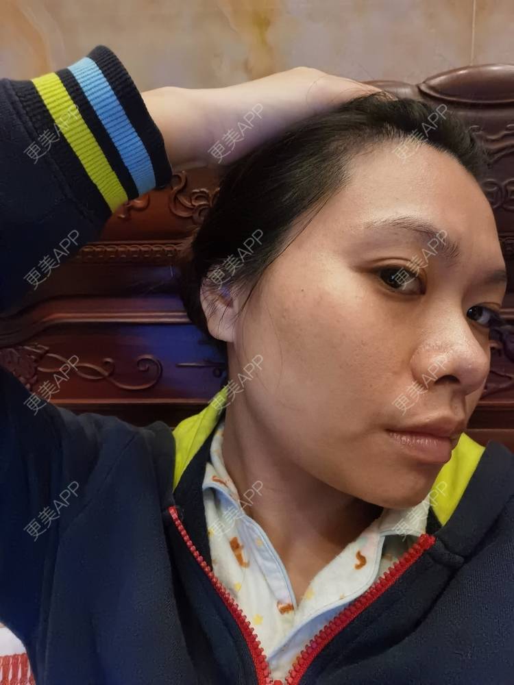 更美 - 油腻叉烧包的皮秒激光经验 | 广州 | 皮秒激光