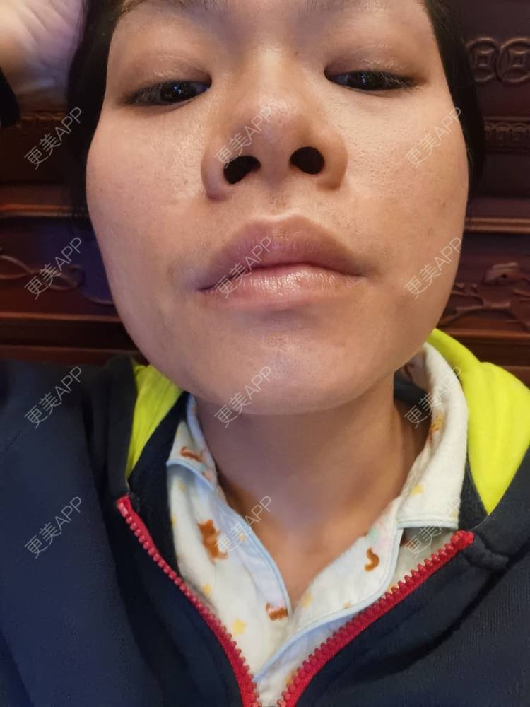 更美 - 油腻叉烧包的皮秒激光经验 | 广州 | 皮秒激光
