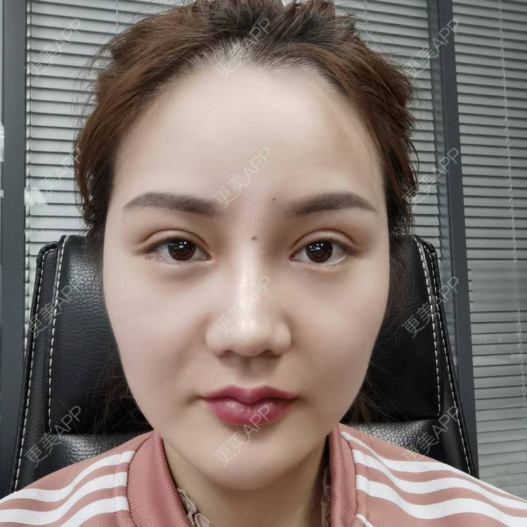 更美 - 河南美时美刻医疗美容的全切双眼皮经验 | 全切双眼皮