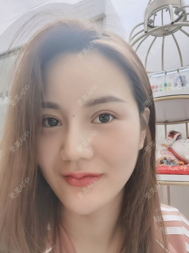 更美 - 河南美时美刻医疗美容的全切双眼皮经验 | 全切双眼皮