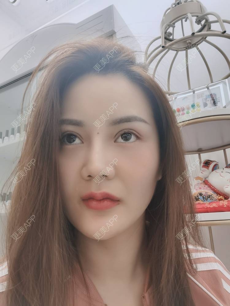 更美 - 河南美时美刻医疗美容的全切双眼皮经验 | 全切双眼皮