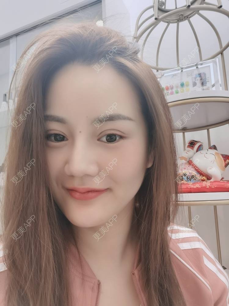 更美 - 河南美时美刻医疗美容的全切双眼皮经验 | 全切双眼皮