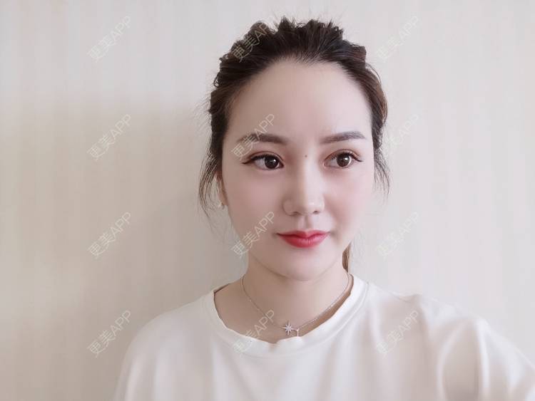 更美 - 河南美时美刻医疗美容的全切双眼皮经验 | 全切双眼皮