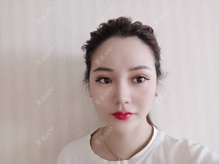 更美 - 河南美时美刻医疗美容的全切双眼皮经验 | 全切双眼皮