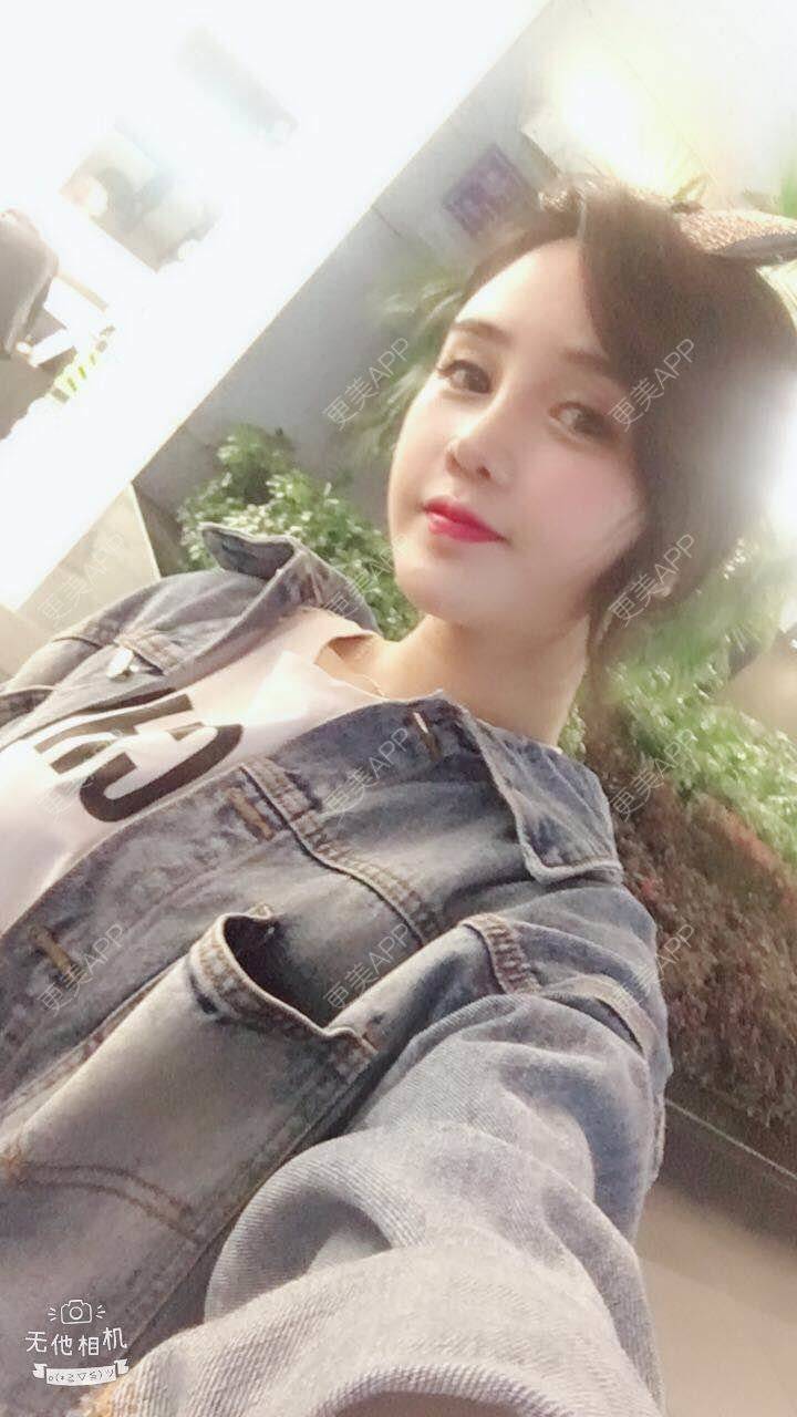更美 - 可可柠檬的自体脂肪丰苹果肌经验 | 重庆 | 自体脂肪丰太阳穴 | 自体脂肪丰面颊 | 自体脂肪丰额头 | 自体脂肪丰苹果肌 | 自体脂肪垫下巴