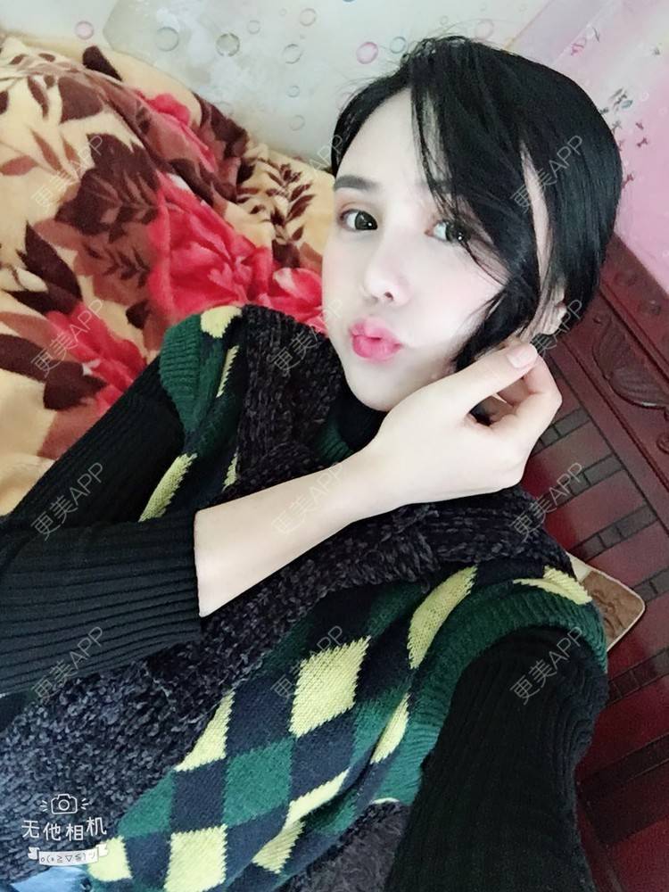 更美 - 可可柠檬的自体脂肪丰苹果肌经验 | 重庆 | 自体脂肪丰太阳穴 | 自体脂肪丰面颊 | 自体脂肪丰额头 | 自体脂肪丰苹果肌 | 自体脂肪垫下巴