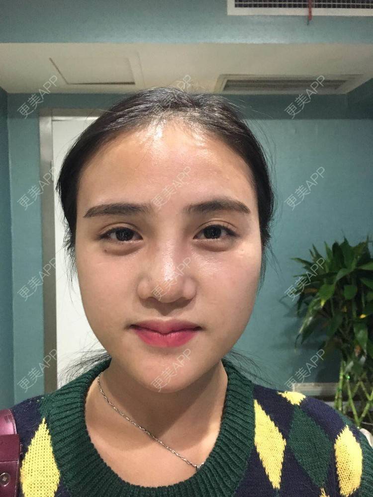 更美 - 可可柠檬的自体脂肪丰苹果肌经验 | 重庆 | 自体脂肪丰太阳穴 | 自体脂肪丰面颊 | 自体脂肪丰额头 | 自体脂肪丰苹果肌 | 自体脂肪垫下巴
