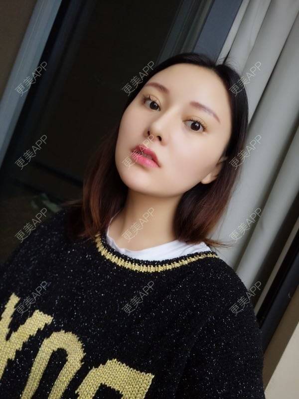 更美 - 天使小妹妹的全切双眼皮经验 | 全切双眼皮 | 重庆