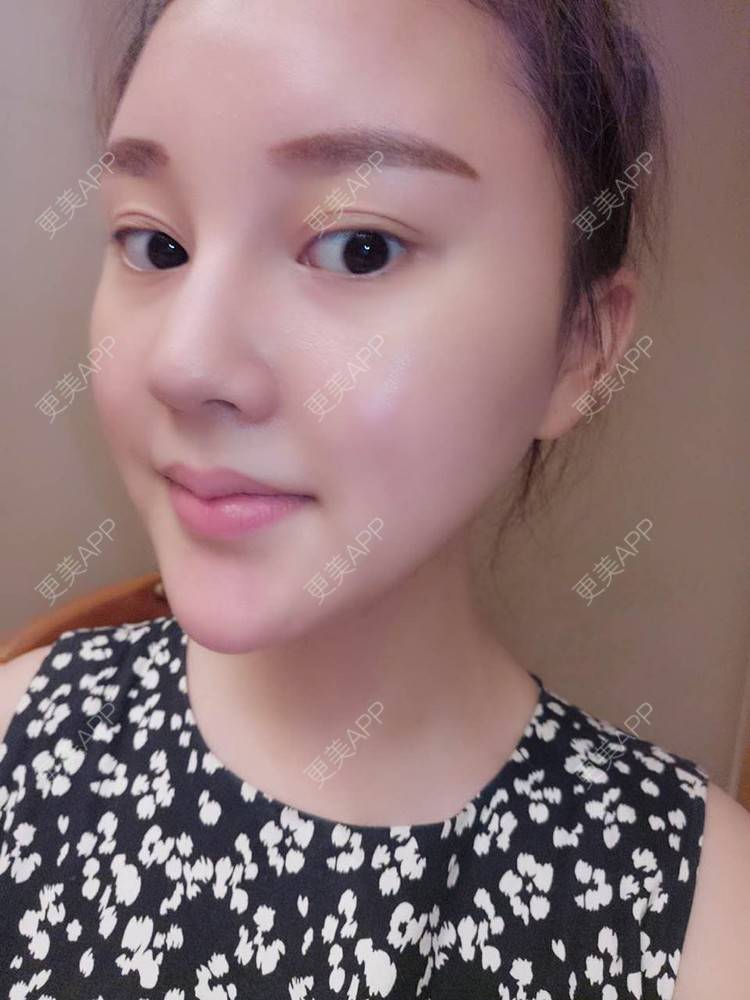 更美 - 天使小妹妹的全切双眼皮经验 | 全切双眼皮 | 重庆