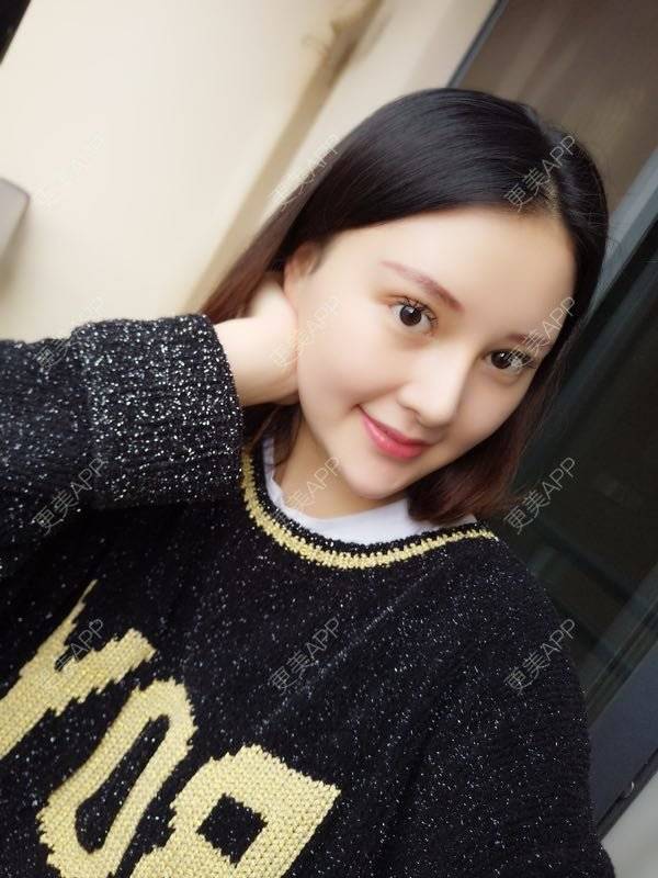 更美 - 天使小妹妹的全切双眼皮经验 | 全切双眼皮 | 重庆