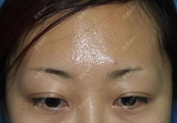 更美 - 更美用户9hJbDy0JWA的植眉经验 | 植眉
