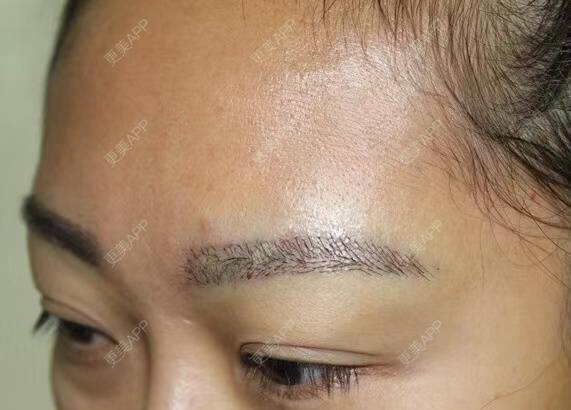更美 - 更美用户9hJbDy0JWA的植眉经验 | 植眉