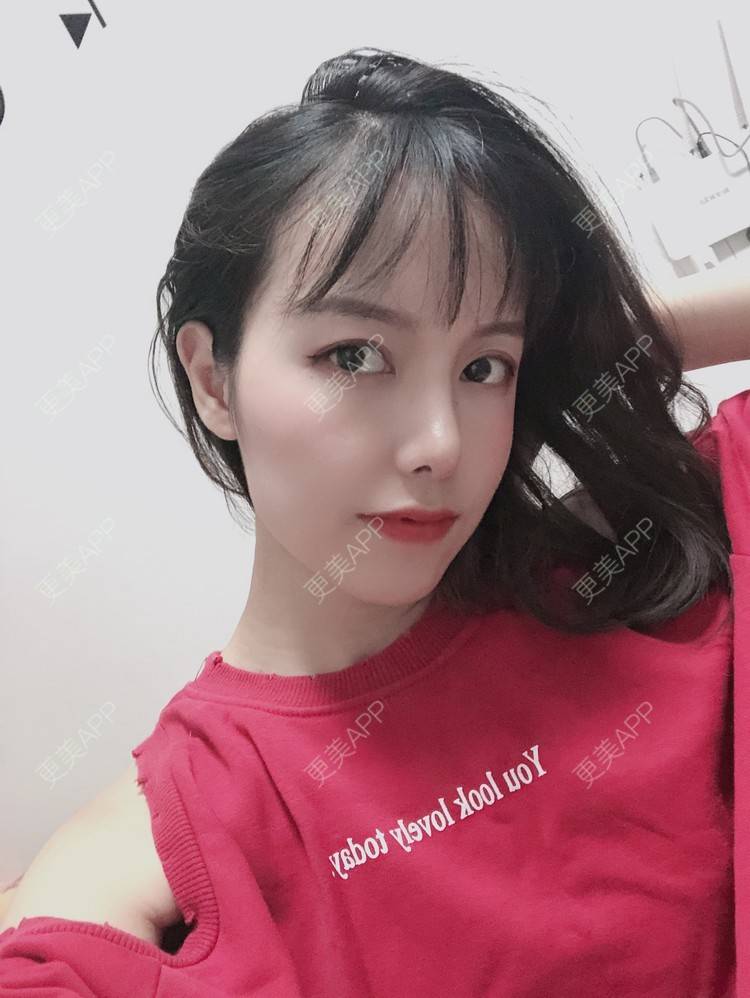 更美 - 咪狐狸的自体脂肪丰面颊经验 | 自体脂肪全面部填充 | 自体脂肪丰面颊 | 深圳 | 自体脂肪面部年轻化 | 自体脂肪面部填充