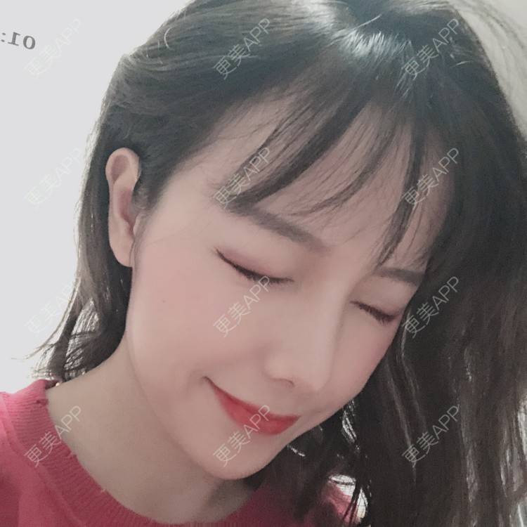 更美 - 咪狐狸的自体脂肪丰面颊经验 | 自体脂肪全面部填充 | 自体脂肪丰面颊 | 深圳 | 自体脂肪面部年轻化 | 自体脂肪面部填充