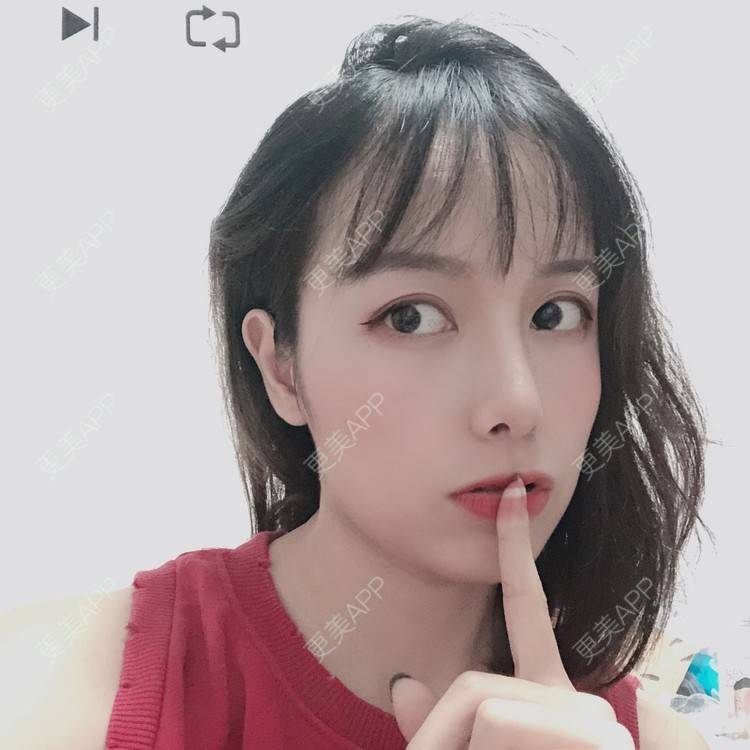 更美 - 咪狐狸的自体脂肪丰面颊经验 | 自体脂肪全面部填充 | 自体脂肪丰面颊 | 深圳 | 自体脂肪面部年轻化 | 自体脂肪面部填充