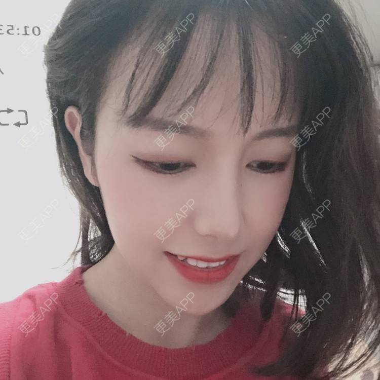 更美 - 咪狐狸的自体脂肪丰面颊经验 | 自体脂肪全面部填充 | 自体脂肪丰面颊 | 深圳 | 自体脂肪面部年轻化 | 自体脂肪面部填充