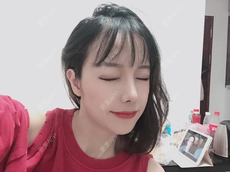 更美 - 咪狐狸的自体脂肪丰面颊经验 | 自体脂肪全面部填充 | 自体脂肪丰面颊 | 深圳 | 自体脂肪面部年轻化 | 自体脂肪面部填充