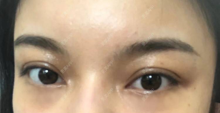 更美 - 更美用户5ID3P7xiEp的胶原蛋白淡化黑眼圈经验 | 胶原蛋白淡化黑眼圈