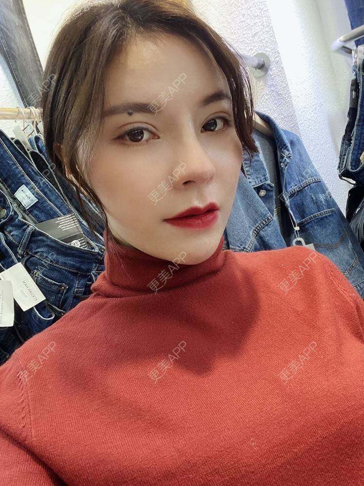 更美 - 更美用户cYoCneHuFl的鼻部多项经验 | 阳江 | 鼻部多项