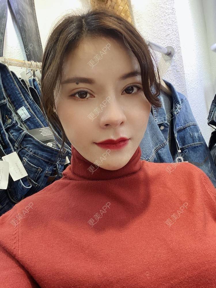 更美 - 更美用户cYoCneHuFl的鼻部多项经验 | 阳江 | 鼻部多项