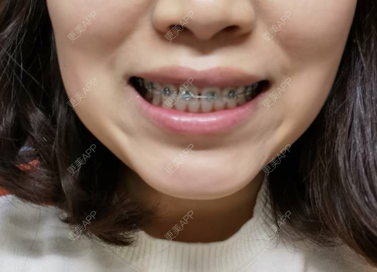 更美 - 更美用户YWdQyE2kiR的金属托槽矫正经验 | 北京 | 金属托槽矫正
