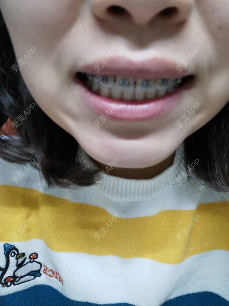 更美 - 更美用户YWdQyE2kiR的金属托槽矫正经验 | 北京 | 金属托槽矫正