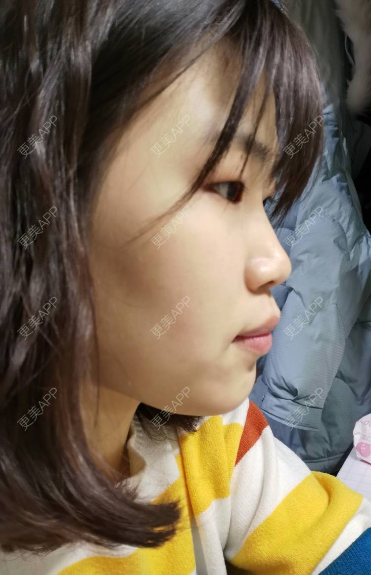 更美 - 更美用户YWdQyE2kiR的金属托槽矫正经验 | 北京 | 金属托槽矫正