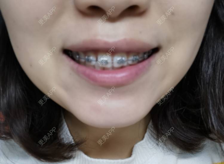 更美 - 更美用户YWdQyE2kiR的金属托槽矫正经验 | 北京 | 金属托槽矫正