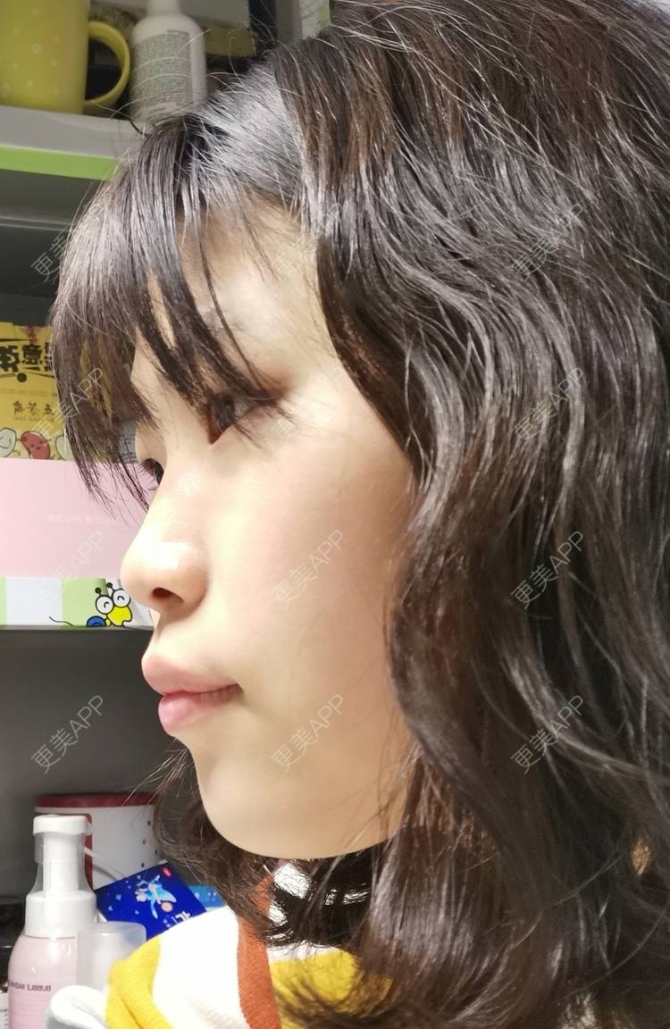 更美 - 更美用户YWdQyE2kiR的金属托槽矫正经验 | 北京 | 金属托槽矫正