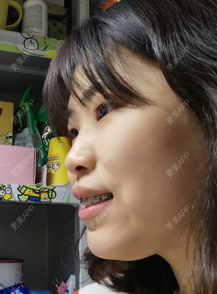 更美 - 更美用户YWdQyE2kiR的金属托槽矫正经验 | 北京 | 金属托槽矫正