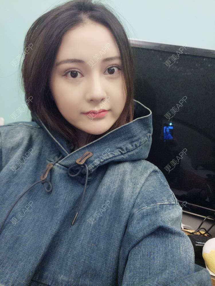 更美 - 天使小妹妹的全切双眼皮经验 | 全切双眼皮 | 重庆