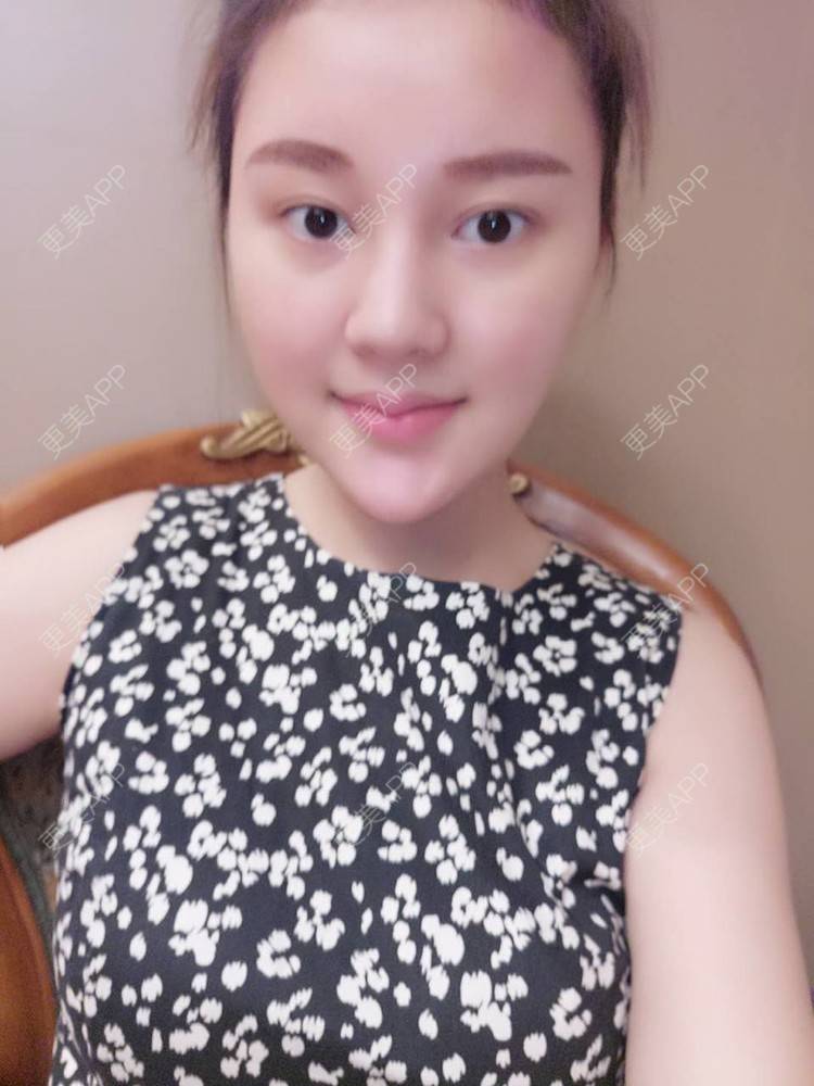 更美 - 天使小妹妹的全切双眼皮经验 | 全切双眼皮 | 重庆