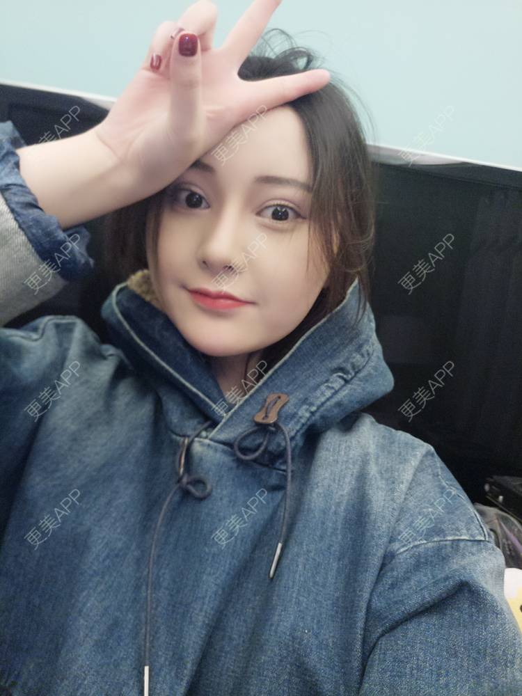 更美 - 天使小妹妹的全切双眼皮经验 | 全切双眼皮 | 重庆