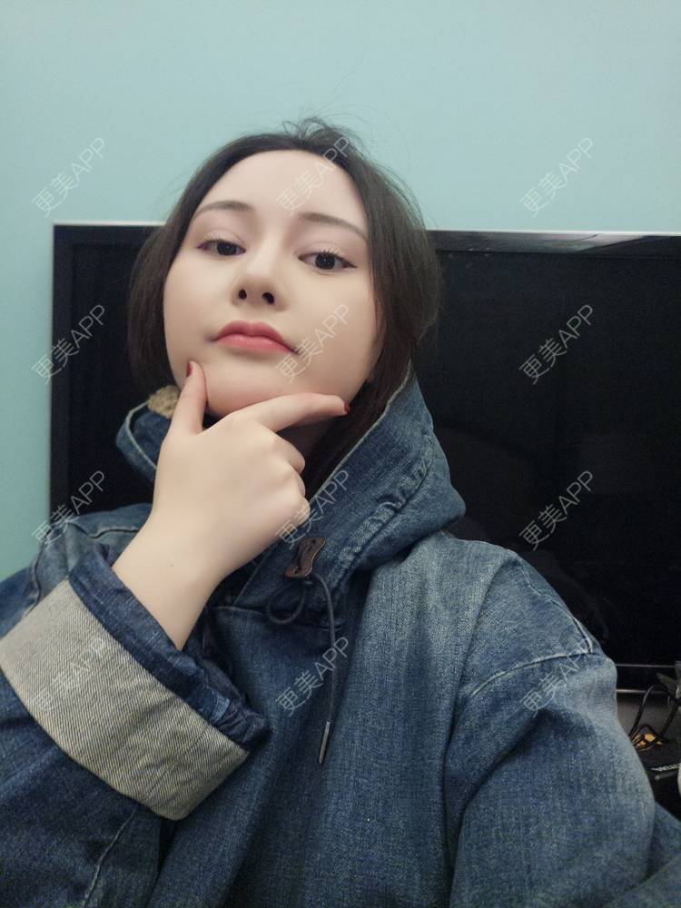 更美 - 天使小妹妹的全切双眼皮经验 | 全切双眼皮 | 重庆