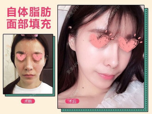 更美 - 更美用户Kagp03q2ym的经验 | 自体脂肪填充法令纹