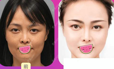 更美 - 更美用户Kagp03q2ym的经验 | 自体脂肪填充法令纹