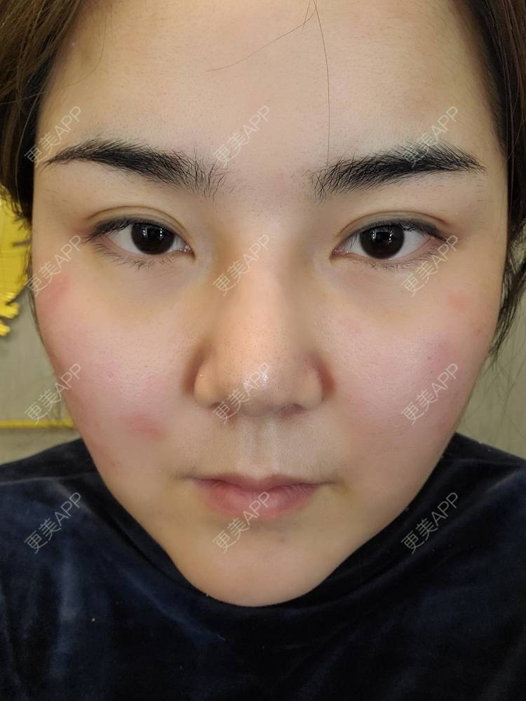 更美 - 夏天盛开的向日葵的硅胶隆鼻经验 | 硅胶隆鼻 | 郑州