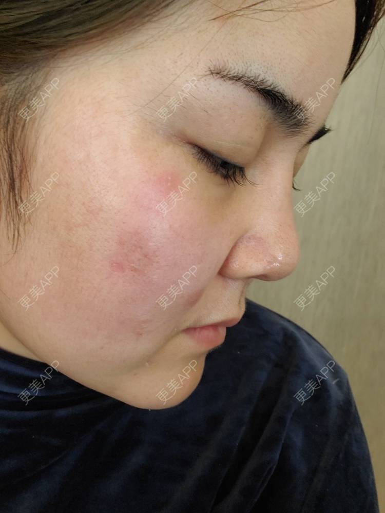 更美 - 夏天盛开的向日葵的硅胶隆鼻经验 | 硅胶隆鼻 | 郑州