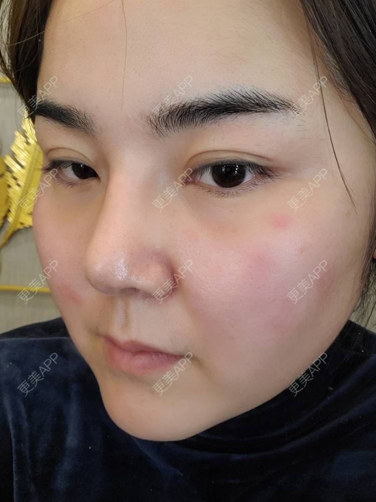 更美 - 夏天盛开的向日葵的硅胶隆鼻经验 | 硅胶隆鼻 | 郑州