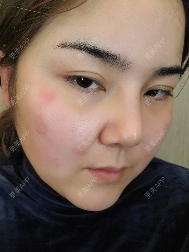 更美 - 夏天盛开的向日葵的硅胶隆鼻经验 | 硅胶隆鼻 | 郑州