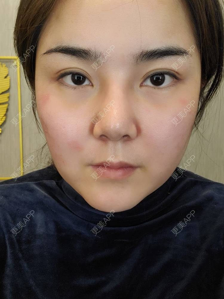 更美 - 夏天盛开的向日葵的硅胶隆鼻经验 | 硅胶隆鼻 | 郑州